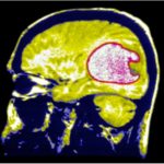 Experimental vaccination might prevent the aggressive brain tumor’s recurrence