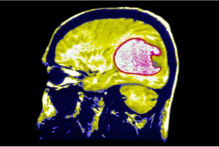 Experimental vaccination might prevent the aggressive brain tumor’s recurrence